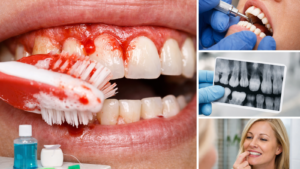 Bleeding-Gums-Gum-Disease-Causes-and-Treatment