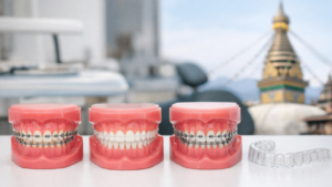 Cost-of-Braces-in-Kathmandu-Metal-vs-Ceramic-vs-Damon-vs-Clear-Aligners